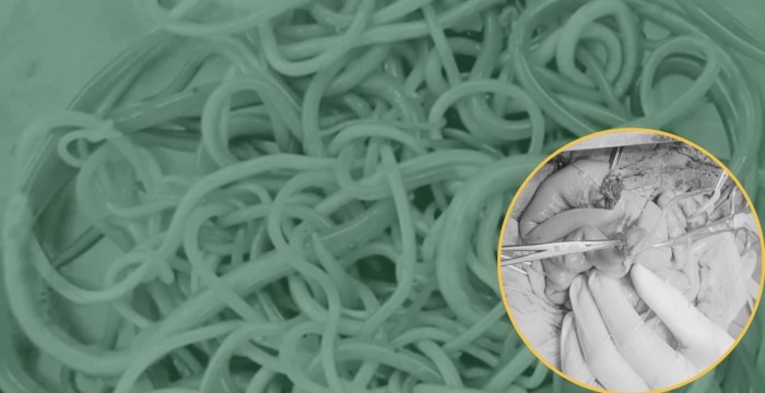 Phát hiện hơn 100 con giun đũa nằm trong ruột của bé trai 2 tuổi rưỡi