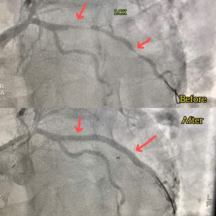 Liên tiếp can thiệp mạch vành cho nhiều bệnh nhân tim mạch