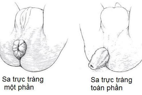 Phân loại sa trực tràng