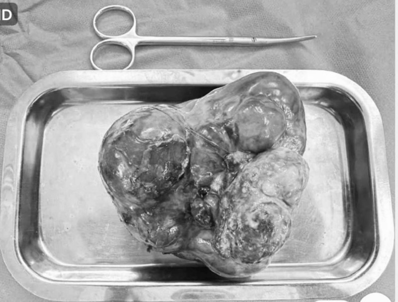 Bé trai sơ sinh đầu tiên tại Việt Nam có khối u quái 'khổng lồ' ở dạ dày hiếm gặp