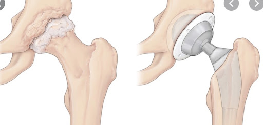 Phục hồi sau thay khớp háng, khớp gối – Hành trình lấy lại vận động tự tin tại bệnh viện 199