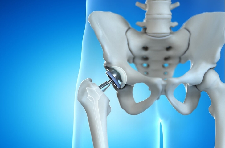 Sau thay khớp háng, khớp gối – Phục hồi vững vàng, sống năng động cùng bệnh viện 199