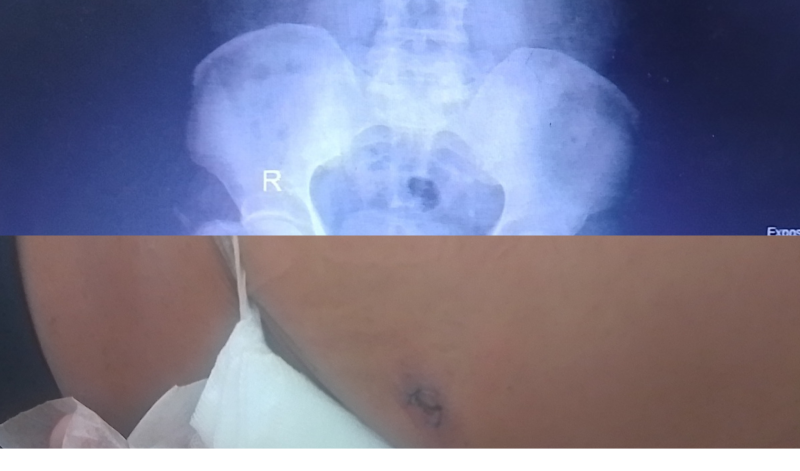 Sỏi thận to, vết mổ nhỏ nhờ phương pháp ứng dụng kỹ thuật cao trong phẫu thuật