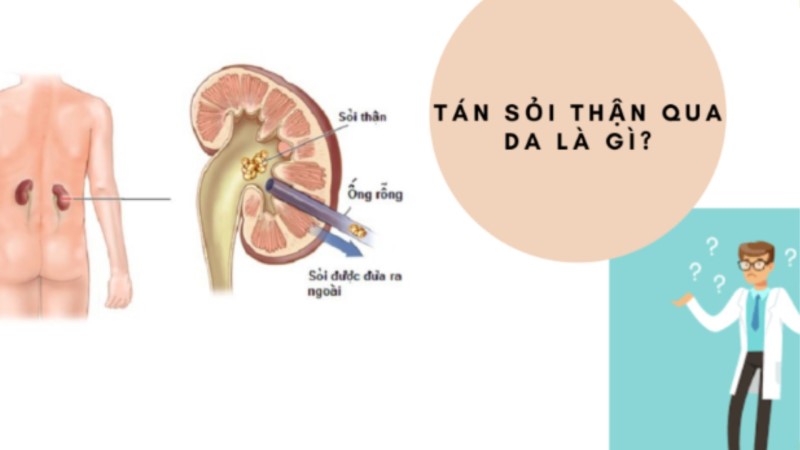 Tán sỏi thận qua da: Phương pháp điều trị sỏi thận, sỏi niệu quản hiệu quả với thời gian phục hồi nhanh chóng.