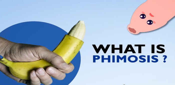 Cắt bao quy đầu về trong ngày