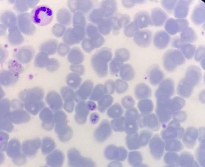 Quảng Bình phát hiện một ca bệnh sốt rét ngoại lai