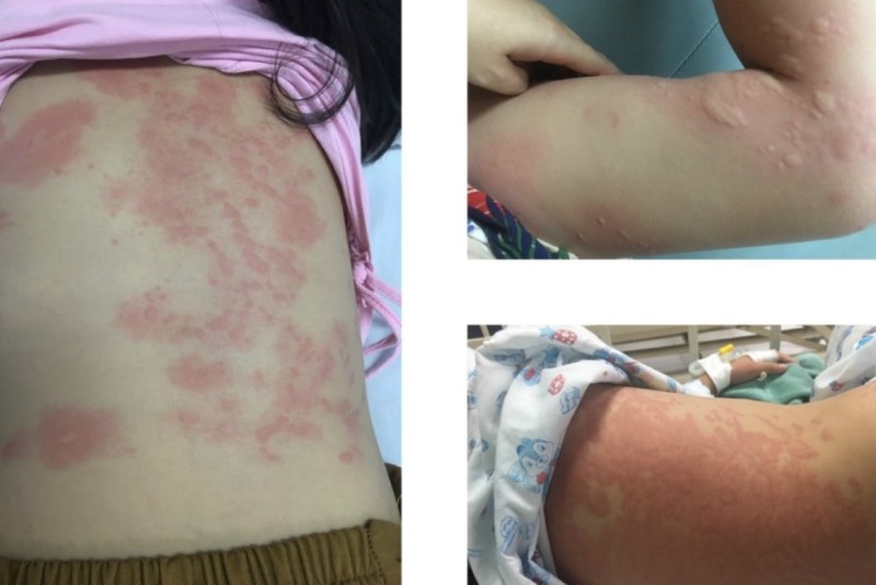 Cảnh giác với triệu chứng nổi mề đay cấp ở trẻ em
